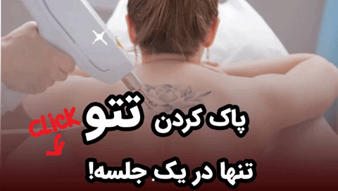 پاک کردن تاتو در تهران